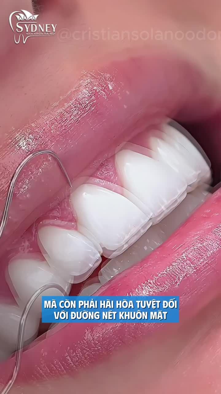 Tiêu chuẩn đánh giá dáng răng sứ đẹp