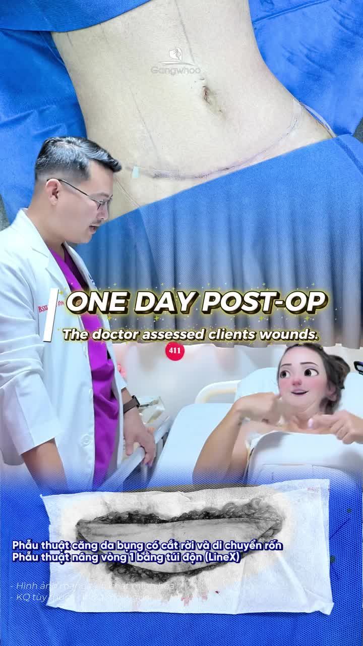 Quá trình hồi phục của khách Quốc Tế Úc sau combo làm đẹp phẫu thuật căng da bụng có cắt rời và di chuyển rốn  + phẫu thuật nâng vòng 1 bằng túi độn (Line X)
