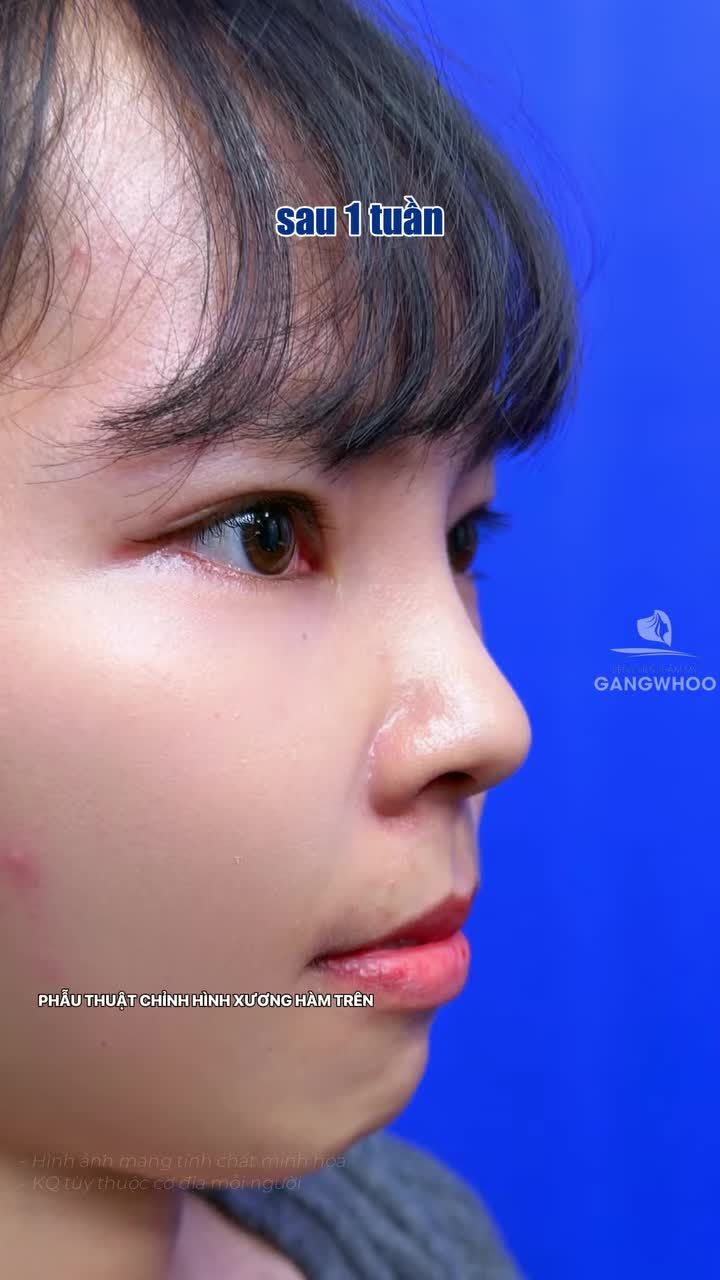 Không phải thay một gương mặt khác. Chỉ là trả lại đúng tỷ lệ cho khuôn mặt vốn có:
