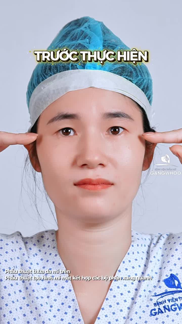 Khách hàng tái khám sau 7 ngày cắt mí và mở góc mắt tron
