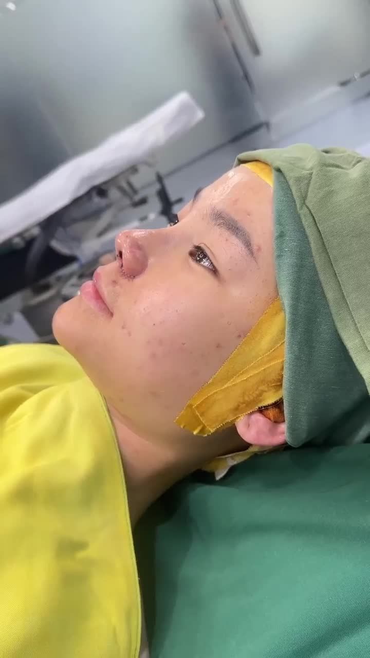SAY BYE MŨI THẤP TẸT CÙNG COMBO NÂNG MŨI CẤU TRÚC + THU NỀN MŨI