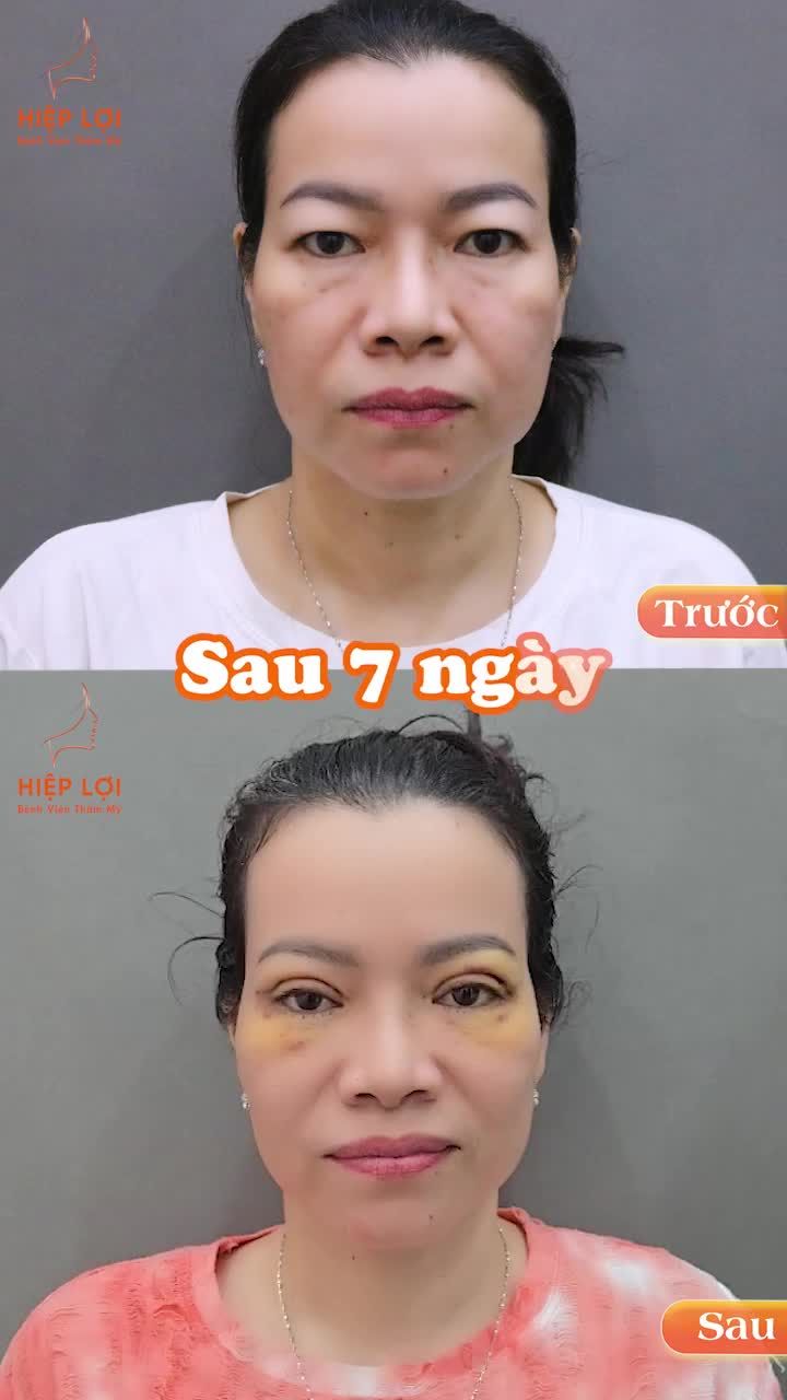 HIỆP LỢI - GIẢI PHÁP CHO ĐÔI MẮT TRẺ ĐẸP