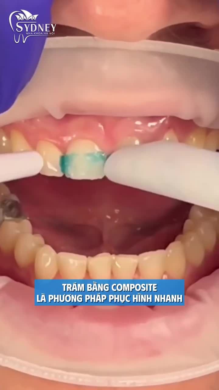 Trường hợp nào nên trám răng thẩm mỹ?