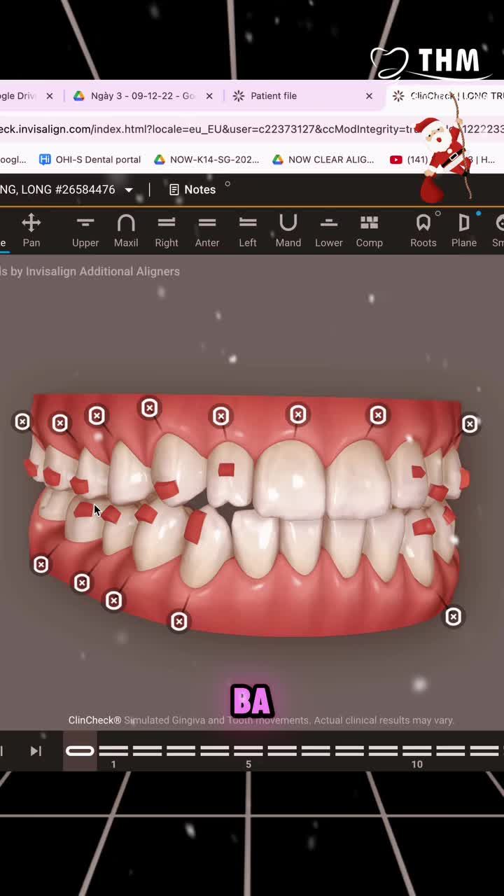 Xem ClinCheck giai đoạn tinh chỉnh – Khay Essential vẫn đạt hiệu quả cao