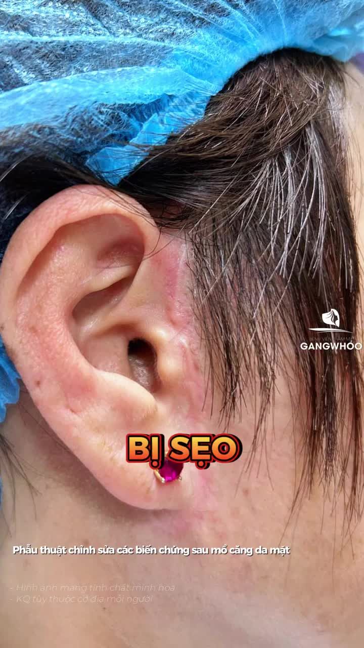 Sau 1 lần căng da thất bại tại Hà Nội chị gái quyết tìm lại thanh xuân của mình với phương pháp phẫu thuật chỉnh sửa các biến chứng sau mổ căng da mặt kết hợp Smas nội soi 4K