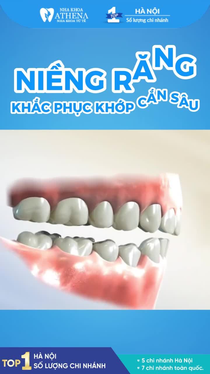 QUÁ TRÌNH "XẾP THẲNG RĂNG" của trường hợp KHỚP CẮN SÂU!