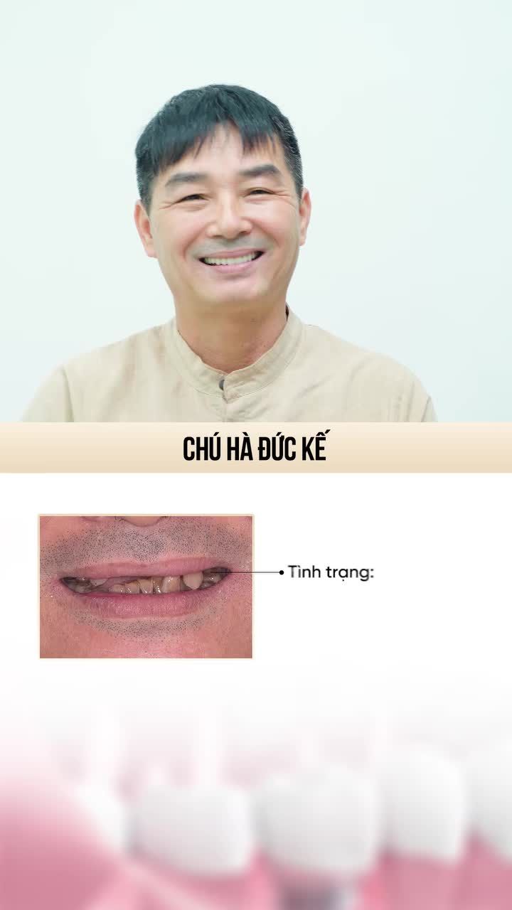 TOP 4 CA CẤY GHÉP IMPLANT TOÀN HÀM THÀNH CÔNG TẠI NHA KHOA GIA ĐÌNH