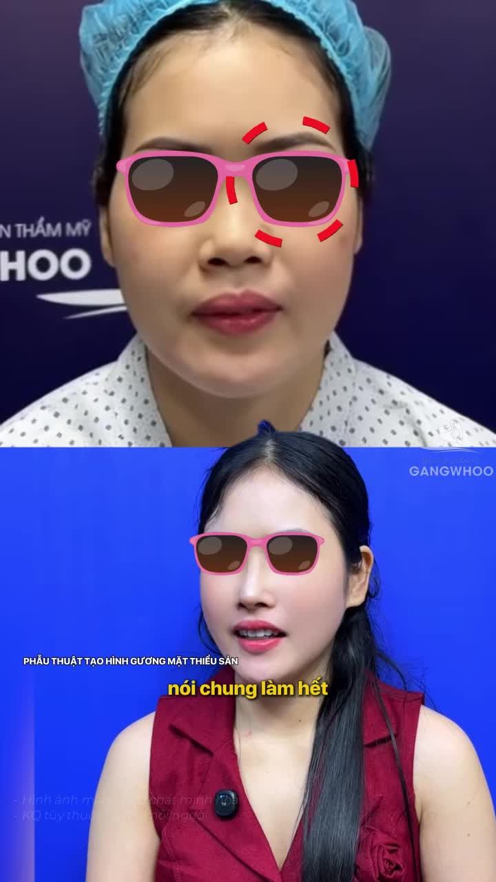 3 tháng nhìn lại... Gương mặt khác đi – thần thái đổi hẳn Cằm gọn, mắt sáng, mũi hài hòa, thái dương đầy vừa đủ. Không còn ngại ống kính. Chỉ còn sự tự tin rất thật