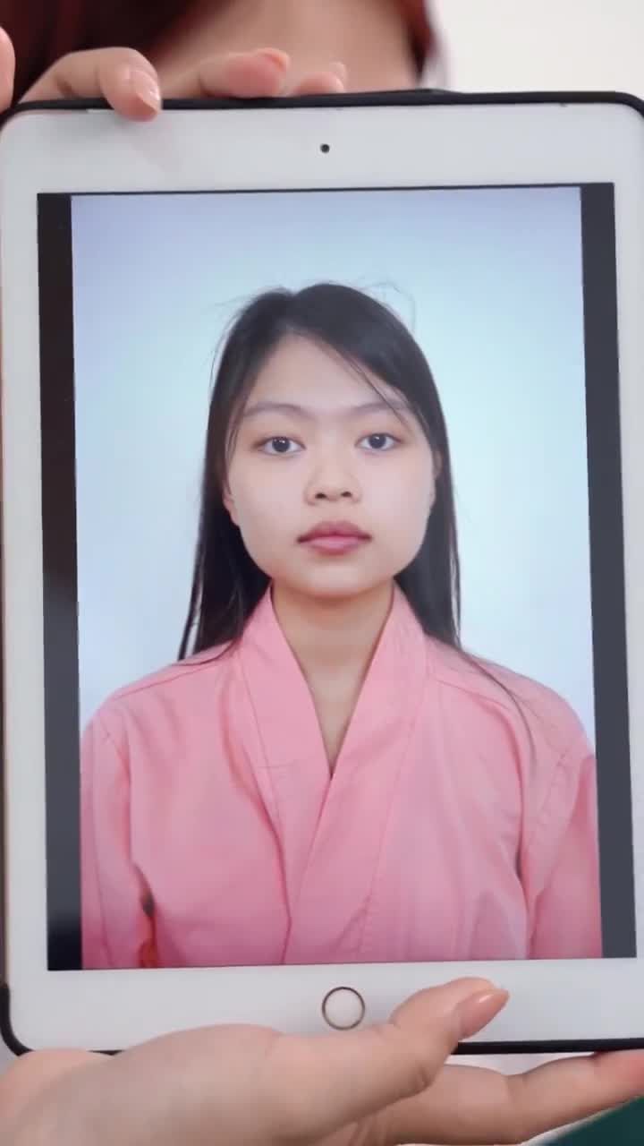 KHOE DÁNG MŨI BỀN ĐẸP SAU 1 NĂM NÂNG MŨI CẤU TRÚC KH. LEE KE TIAN (SINGAPORE)