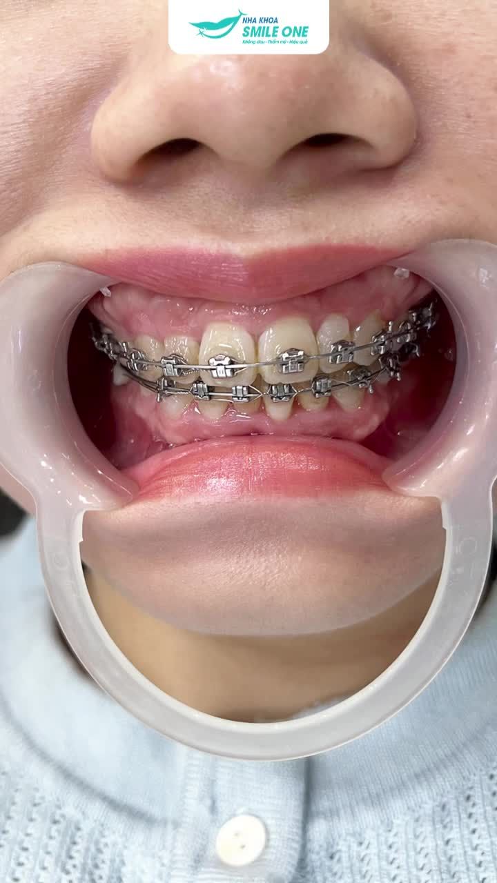 Định luật nào cấm người trưởng thành niềng răng? Ở đây Smile One đã thành công rất rất nhiều ca trưởng thành tới niềng răng, kết quả đều vượt ngoài mong đợi.