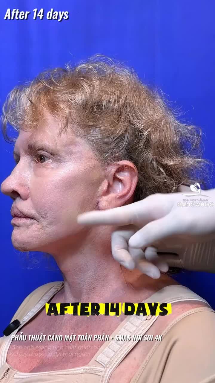 Hành trình trẻ hóa tuyệt vời của chị khách Quôc Tế sau 1 tháng thực hiện phẫu thuật căng mặt toàn phần + Smas nội soi 4K