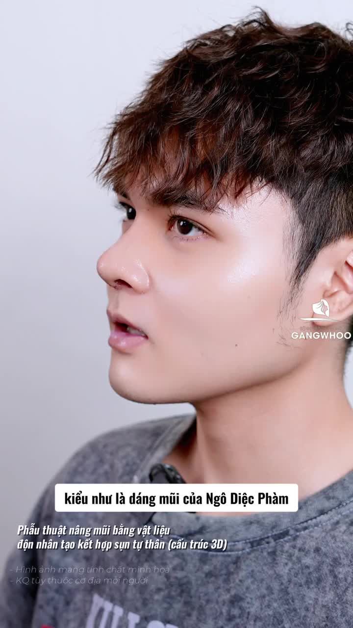 Khi ước mơ sở hữu dáng mũi giống idol Trung Hoa trở thành sự thật. Phẫu thuật nâng mũi bằng vật liệu độn nhân tạo kết hợp sụn tự thân (cấu trúc 3D)