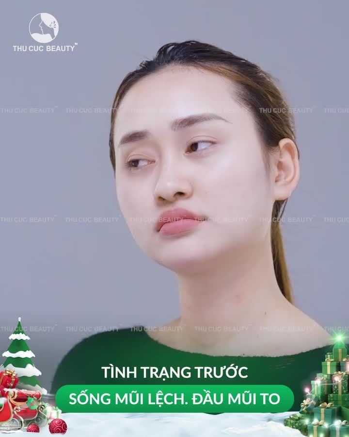 Check dáng mũi sau 1 tháng nâng mũi tại Thu Cúc