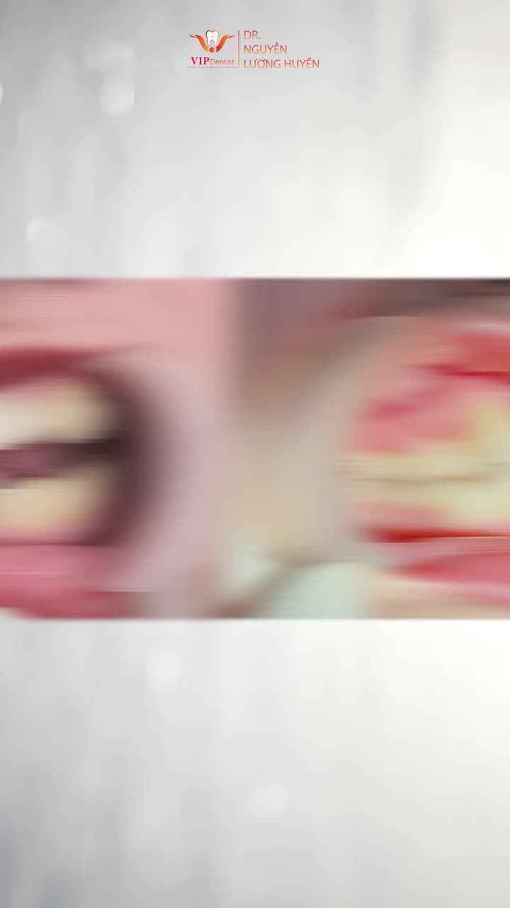 Chị nữ khách hàng đã khắc phục tình trạng răng khấp khểnh với phác đồ Niềng Răng Không Nhổ Răng tại VIP Dentist như thế nào?