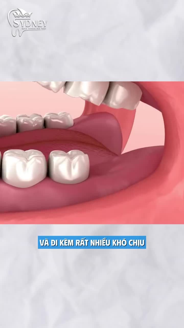 Dấu hiệu cho thấy bạn đang mọc răng khôn