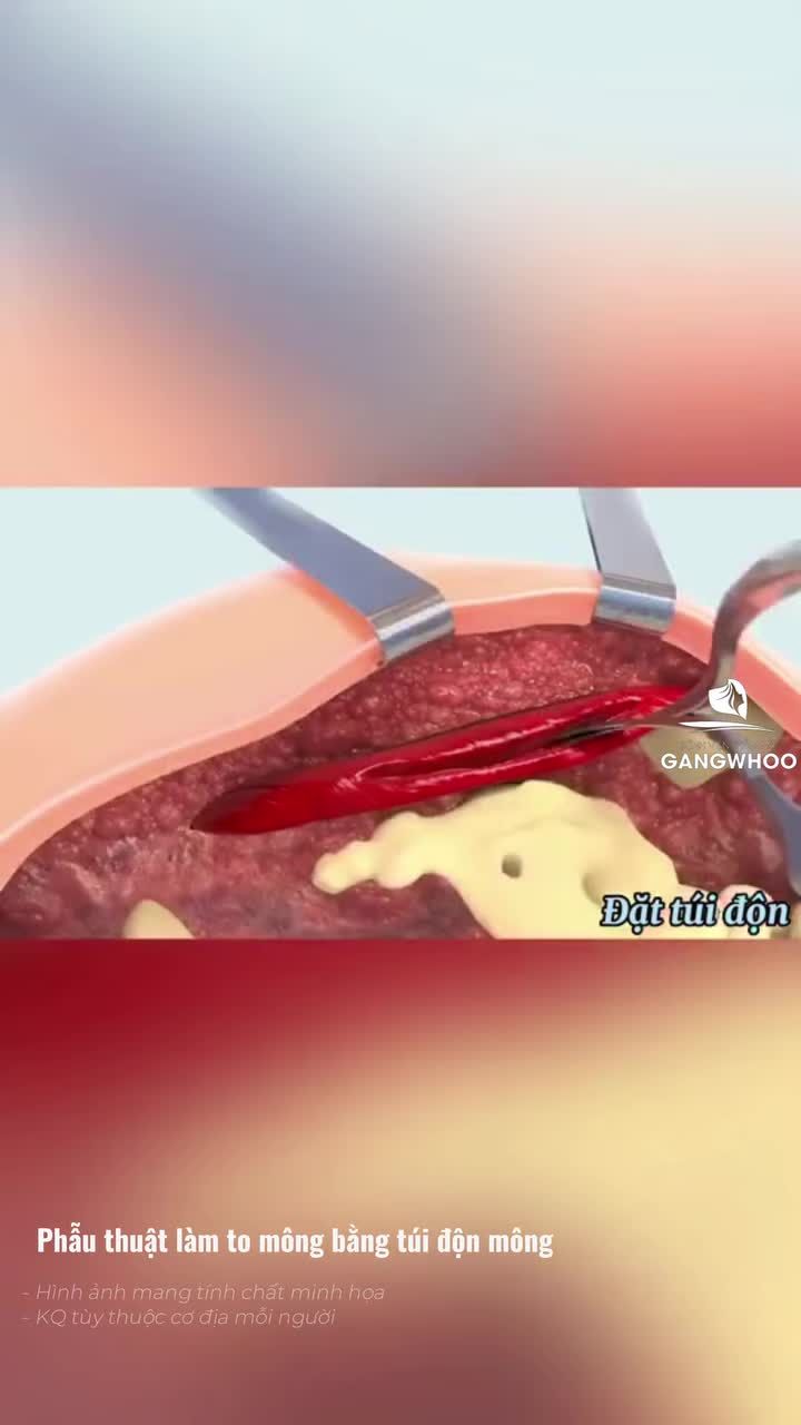 Nâng V3 nội soi thì đẹp chuẩn form, mau lành thương