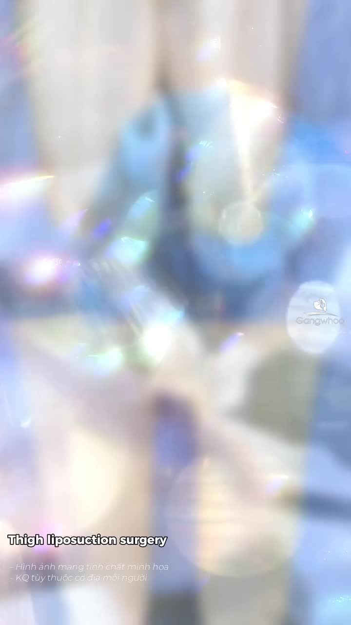 Kết quả phẫu thuật hút mỡ đùi cho khách Quốc tế Pháp sau phẫu thuật 30 phút.