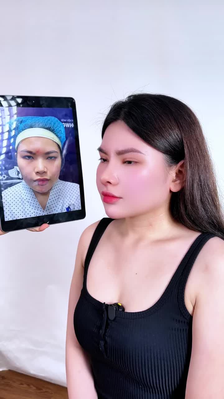 COMBO MŨI & MÍ SAU 2 TUẦN – NHAN SẮC THĂNG HẠNG, TỰ TIN 9/10 ĐIỂM