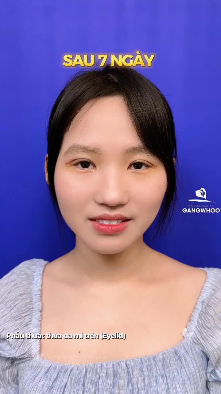 Kết quả sau 7 ngày cắt mí Eyelid, bạn chia sẻ quá trình chăm sóc tại nhà đơn giản và hài lòng với dịch vụ tại Gangwhoo.