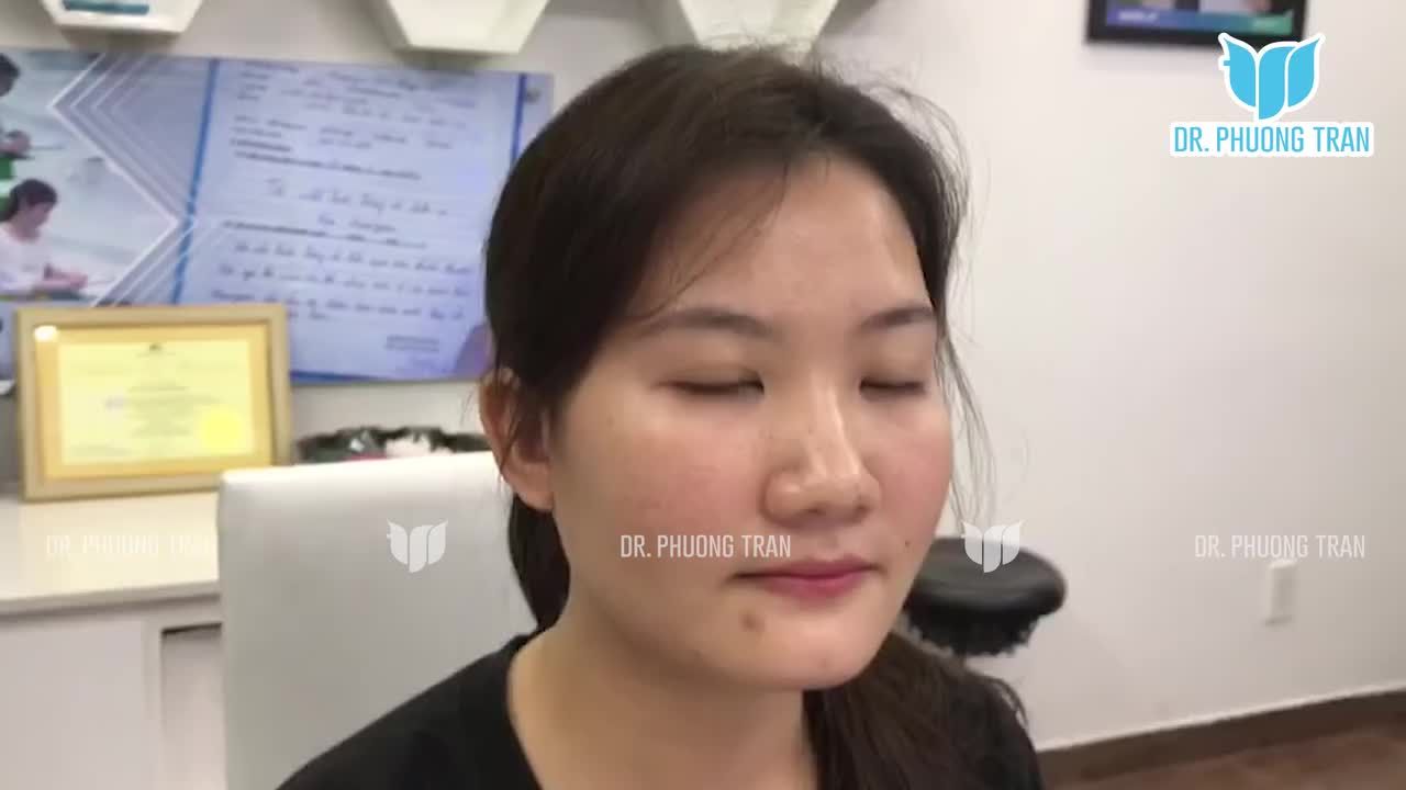 Đây là hình ảnh trước phẫu thuật của một bạn nữ có phần sống mũi thấp, hơi lệch, tuy nhiên đầu mũi tương đối hài hòa.