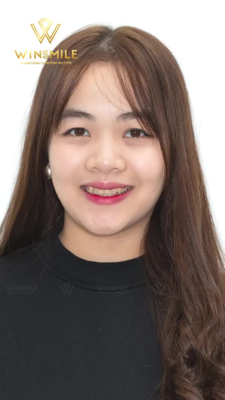 KHÔNG SỢ RĂNG SỨ XẤU, CHỈ SỢ KHÔNG THUYẾT PHỤC ĐƯỢC CHỒNG CHO ĐI LÀM RĂNG