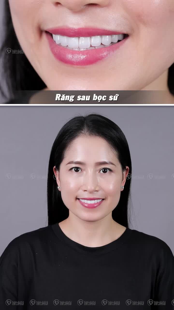 Nụ cười mới sau làm răng sứ tại VIET SMILE
