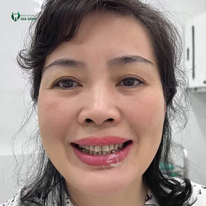 TẾT ĐẾN NƠI RỒI, ĐỪNG ĐỂ KHUYẾT ĐIỂM HÀM RĂNG GIỮ BẠN LẠI PHÍA SAU