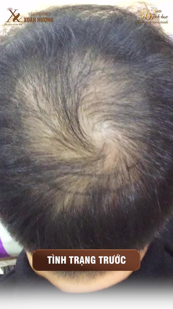 PHÁ VỠ RÀO CẢN TỰ TI VỚI MÁI TÓC DÀY VÀ ĐỀU MÀU HƠN