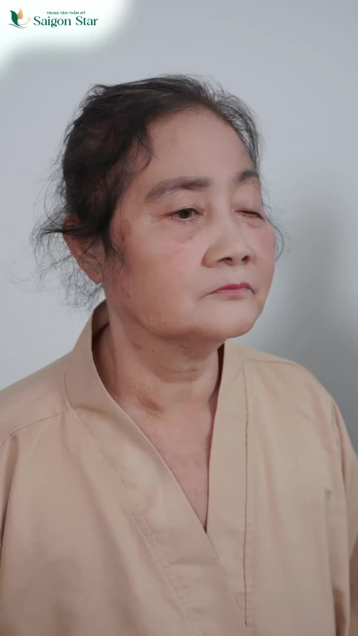 BÁC SĨ HOẠT THÀNH CÔNG "GIẢI CỨU MÍ SỤP CHO CÔ KHÁCH HÀNG U70