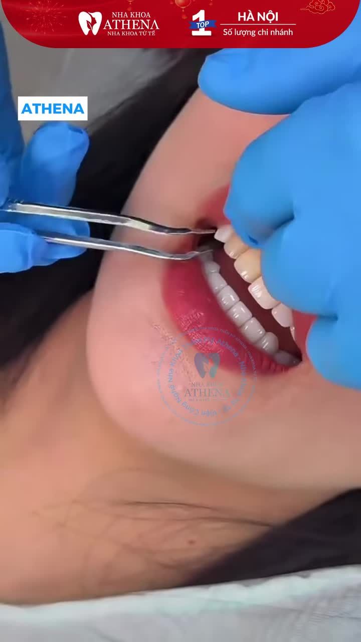 Bạn muốn thay đổi nụ cười nhưng sợ cảm giác mài răng  Bạn lo lắng bọc sứ sẽ làm nụ cười thiếu tự nhiên