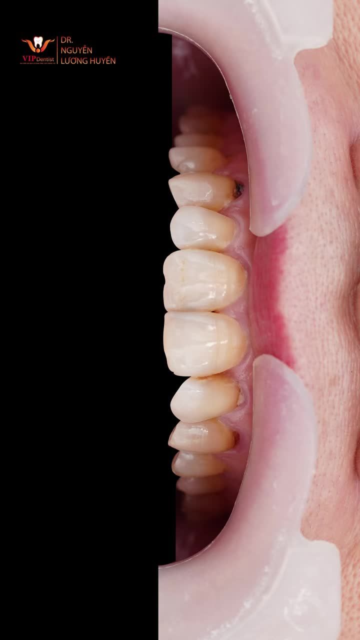 Thẩm mỹ răng sứ không chỉ thay đổi nụ cười – mà còn định hình thần thái, giúp khách hàng tự tin hơn với chính bản thân mình!