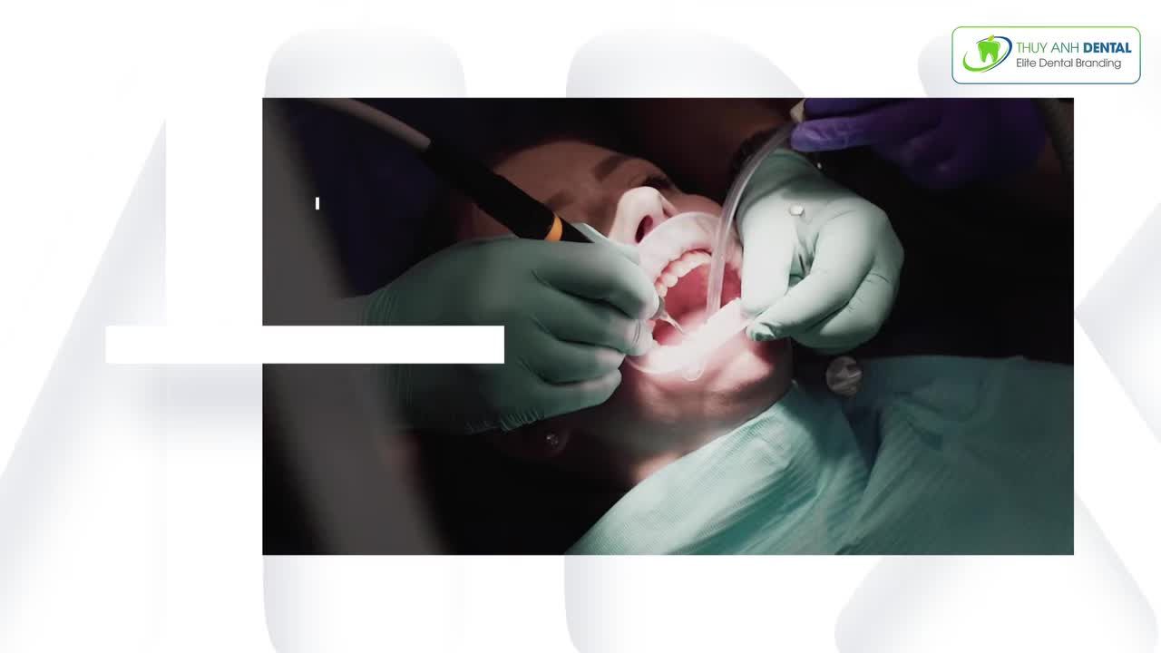 TRỒNG RĂNG IMPLANT TẠI VIỆT NAM – VIỆT KIỀU KHÁCH QUỐC TẾ CẦN CHUẨN BỊ GÌ?