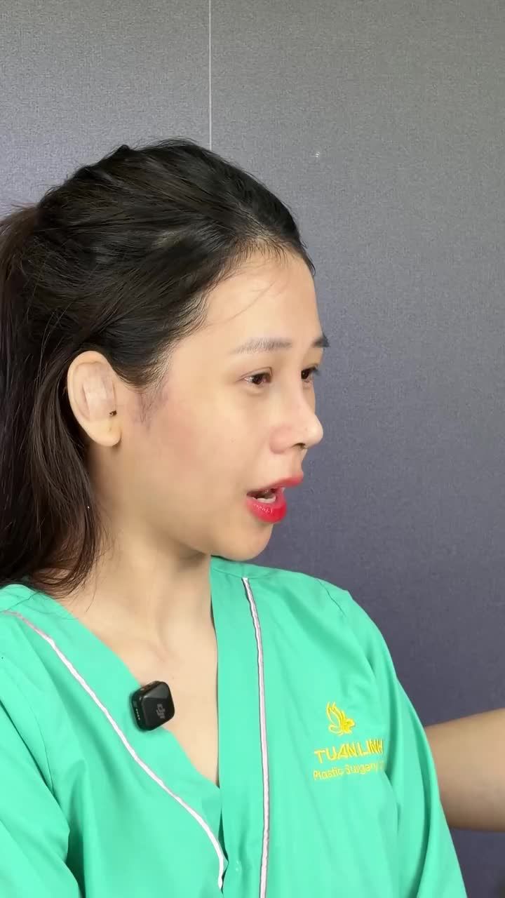 Từng chọn tiêm filler để nâng mũi nhưng không ưng ý, chờ filler tan nhưng chờ 7 năm filler không hề tan.