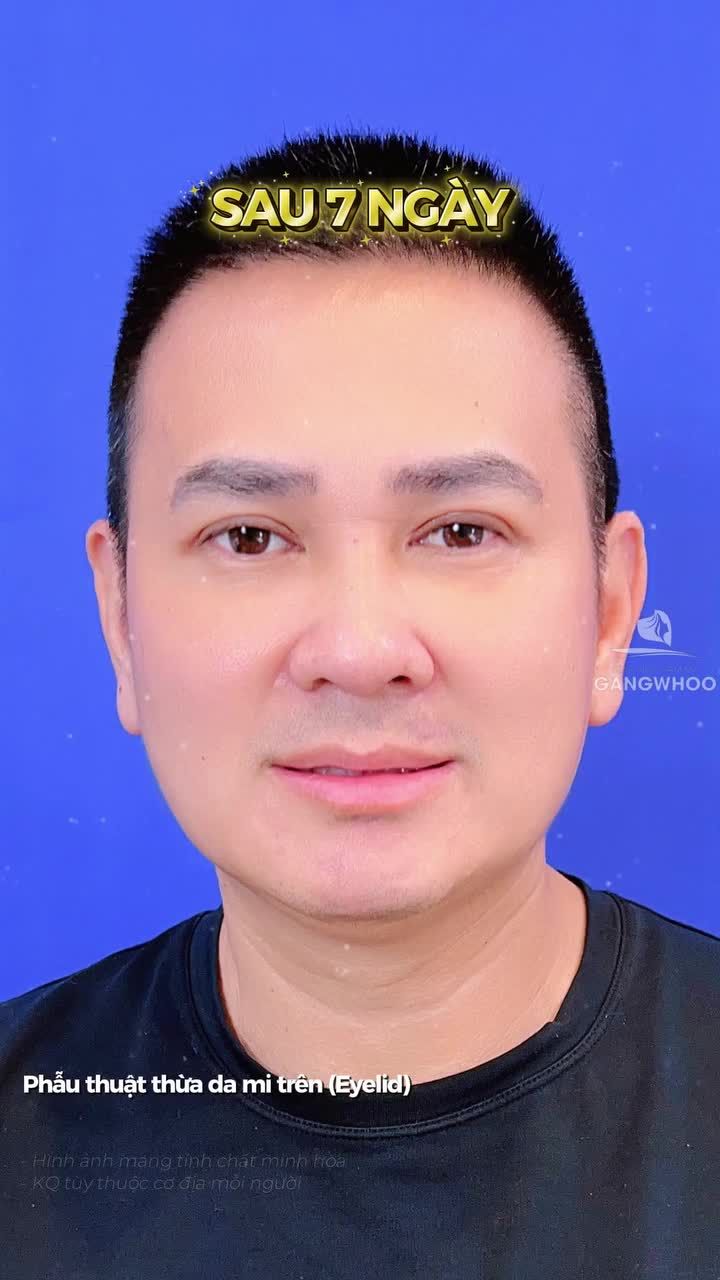 Về thăm gia đình dịp đầu năm, anh cũng tranh thủ nâng cấp đôi mắt.