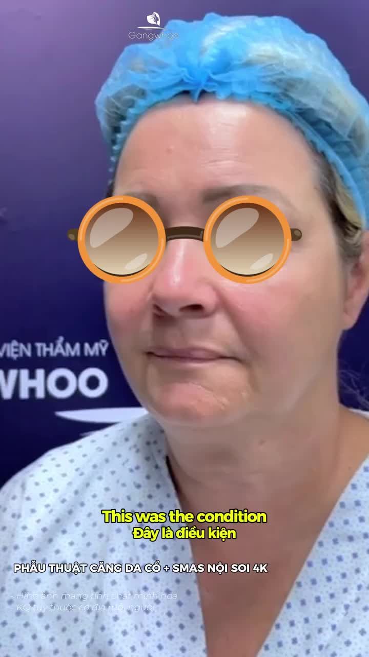 Chị khách bất ngờ với kết quả sau phẫu thuật căng da cổ + Smas nội soi 4K
