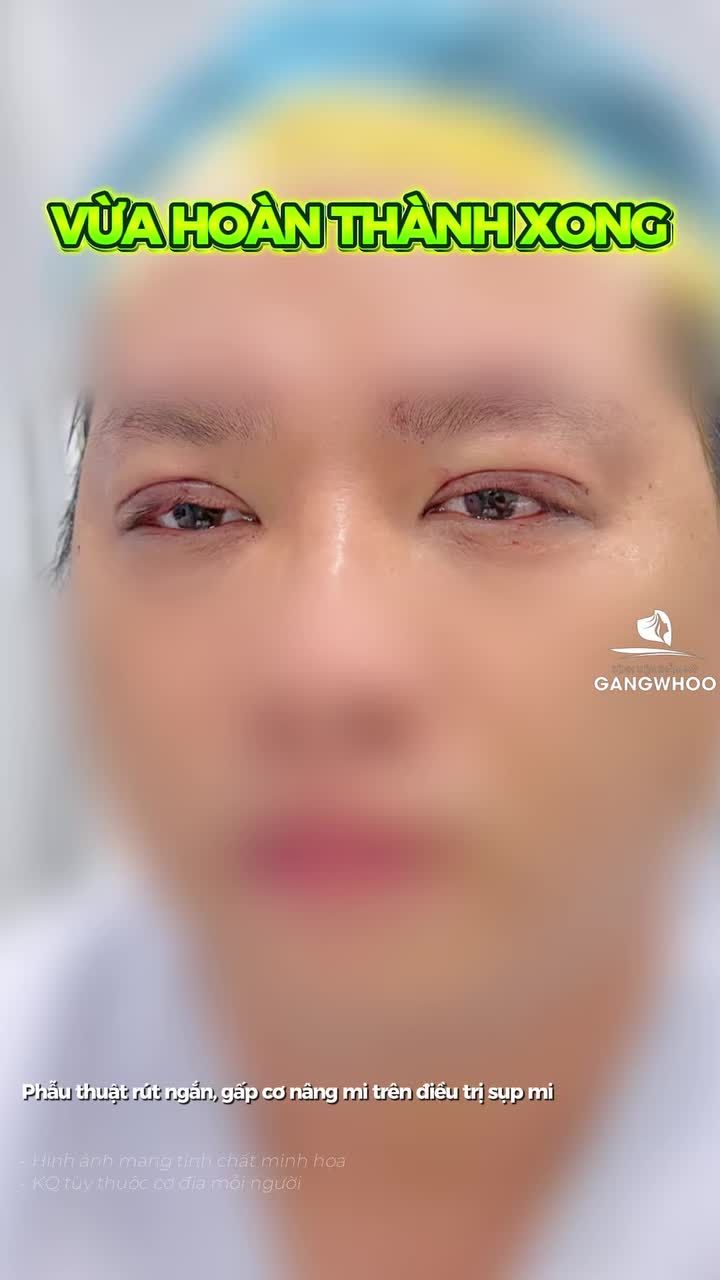 Anh khách U50 gặp tình trạng sụp cơ nâng mi, mong muốn lấy lại tầm nhìn rõ ràng hơn.