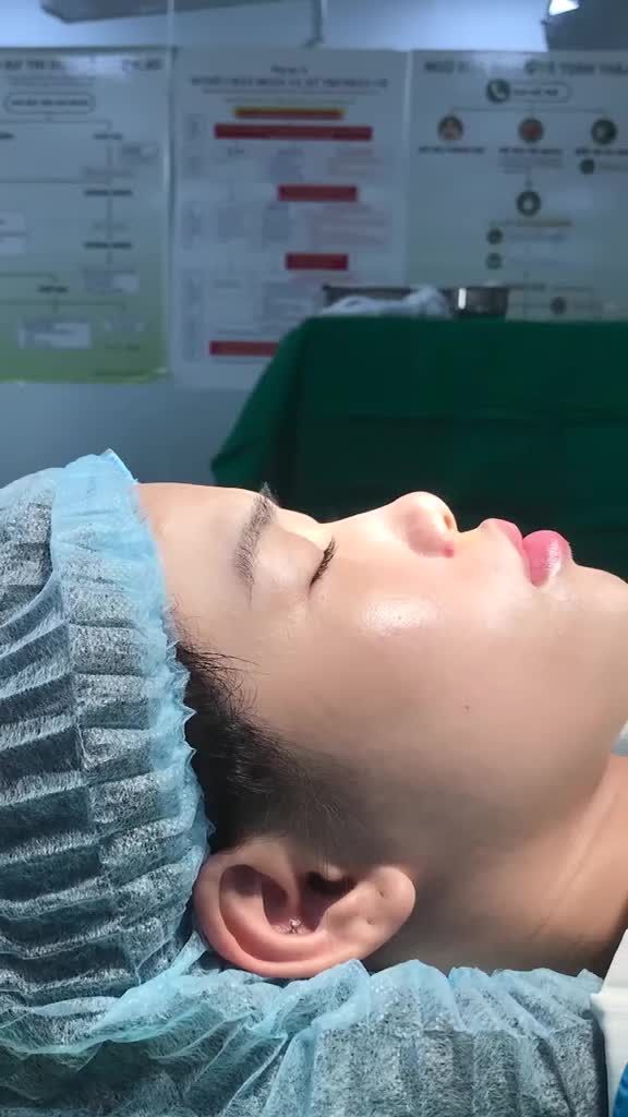 Da mỏng vì sao nên làm mũi cấu trúc?  Nâng mũi giảm đến 50%