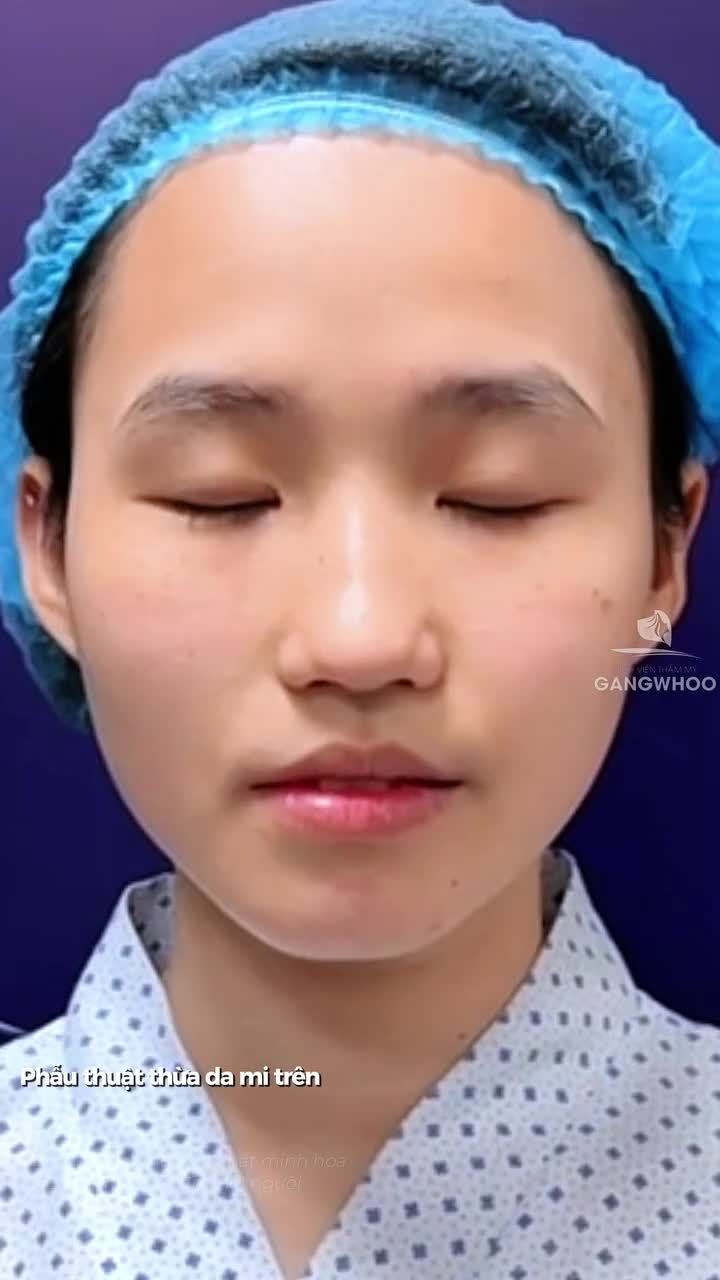 Sẵn sàng thay đổi diện mạo đón TẾT ...chỉ khoảng 45 phút cho một đôi mắt hai mí rõ nét gương mặt bật sáng.