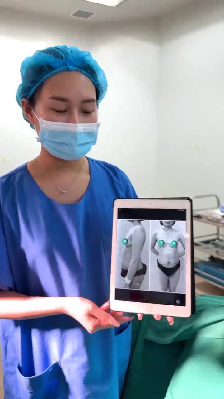 Hoàn thành combo Nâng ngực Nagor SVN - Hút mỡ siết eo - Cấy mỡ hõm mông - Cấy mỡ mặt