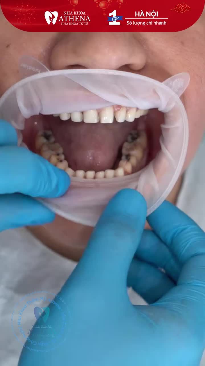 Khắc phục mọi khuyết điểm, chào đón nụ cười rạng rỡ và tự nhiên với DÁN SỨ VENEER