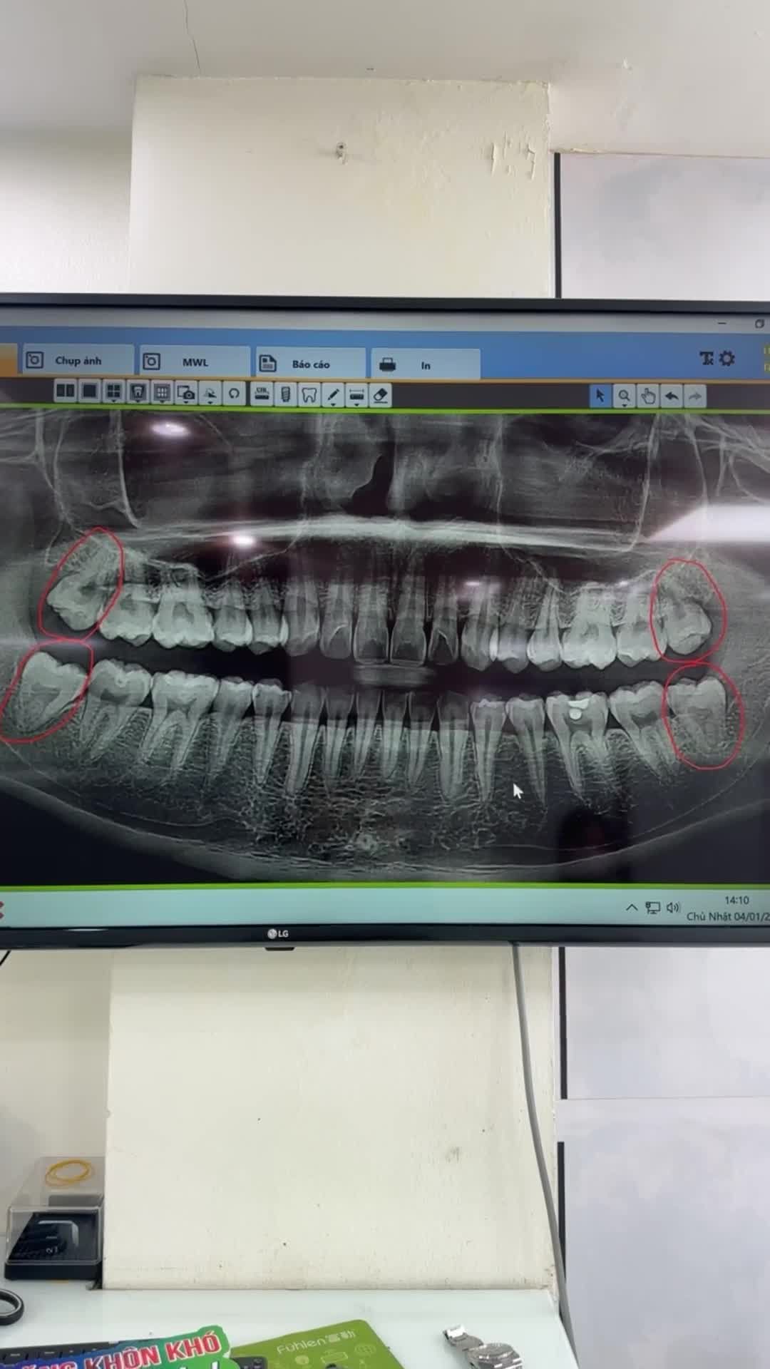Ca nhổ răng khôn số 28 mọc lệch má; 38 mọc kẹt lợi trùm gây đau nhức cho khách hàng