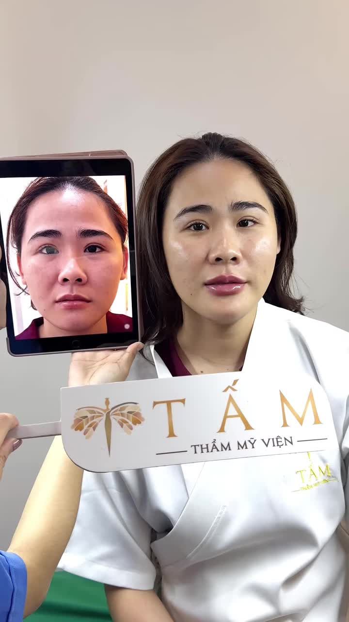 Khách hàng tới cầu cứu Tấm sau khi tiêm filler tại địa chỉ khác bị lồi lõm