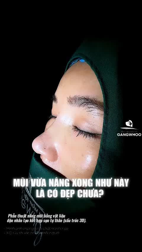 Mũi vừa nâng xong mà đã đẹp như này rồi sao?