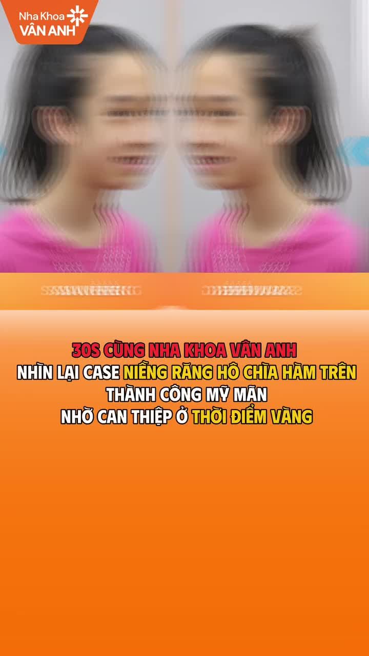 Chỉ 30 giây để thấy rõ lột xác ngoạn mục của chỉnh nha thời điểm vàng.