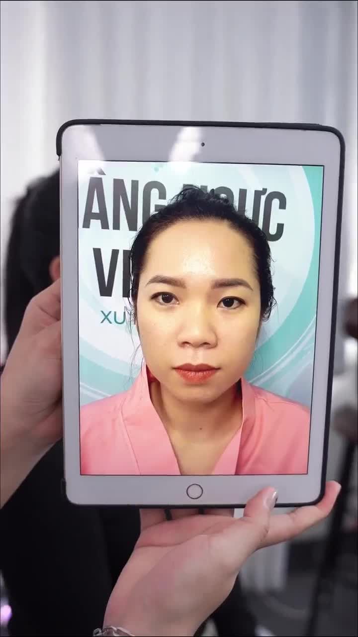 TRƯỚC VÀ SAU 10 NGÀY NÂNG MŨI CẤU TRÚC DR. HOẠT SẼ RA SAO???