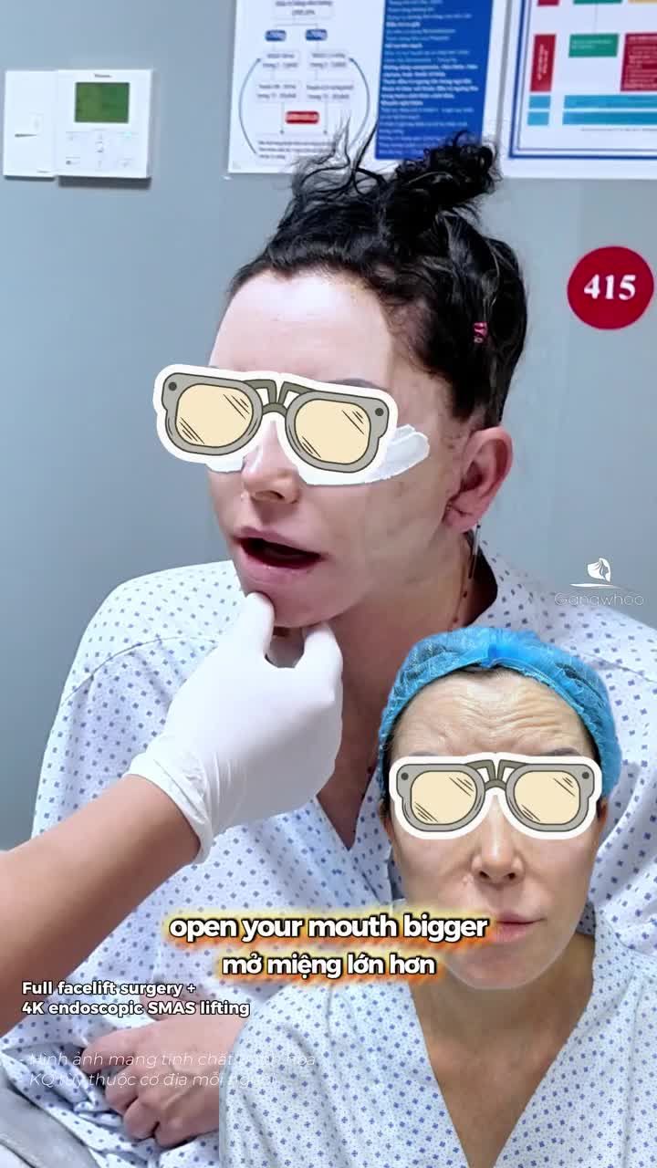 Khách quốc tế phải WOW với kết quả sau khi phẫu thuật căng da mặt toàn phần + Smas nội soi 4K