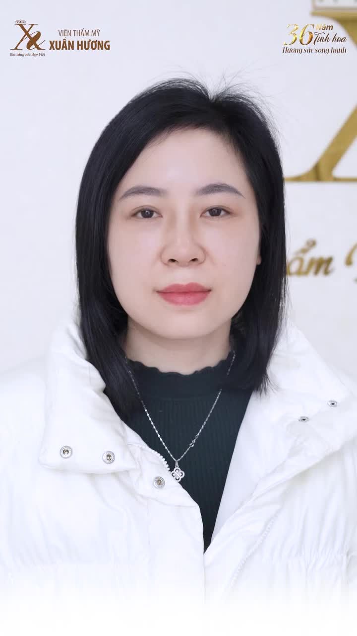 TRẺ RA CẢ CHỤC TUỔI NHỜ COMBO CẮT MÍ DƯỚI NÂNG MŨI