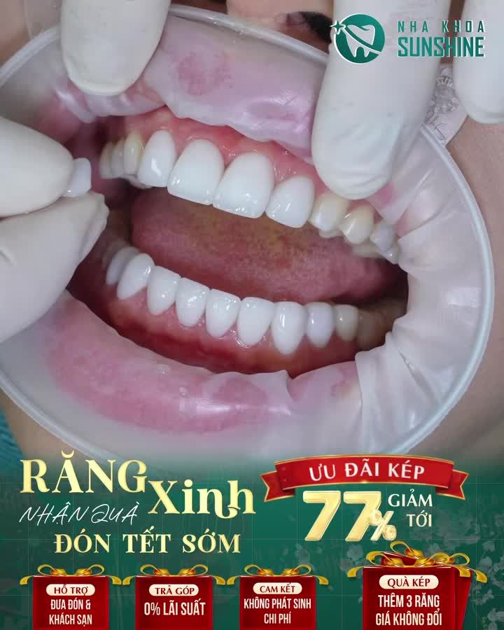 LÀM RĂNG ĐẸP ĐÓN TẾT SỚM - ƯU ĐÃI LÊN ĐẾN 77% + giá trị khác.