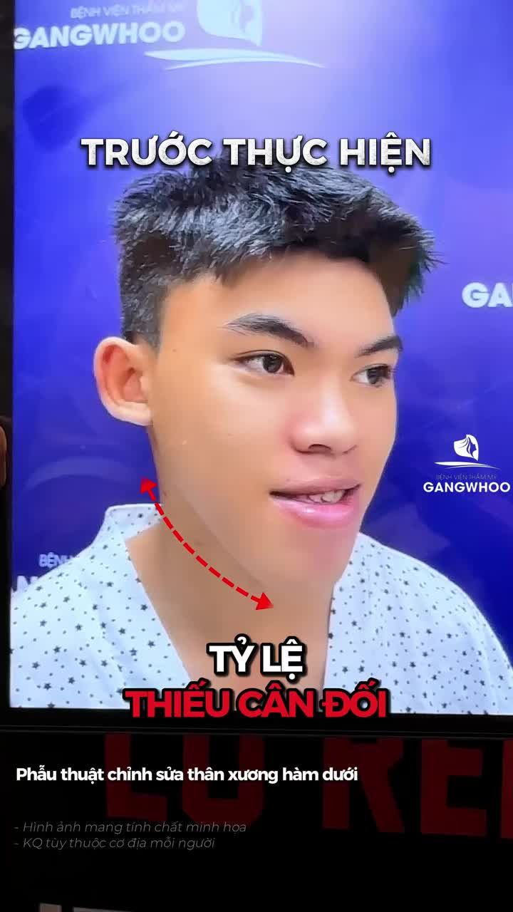 Trước thì cười còn ngại vì khớp cắn lệch Sau thì hàm cân xinh, nụ cười bật mood Gen Z liền