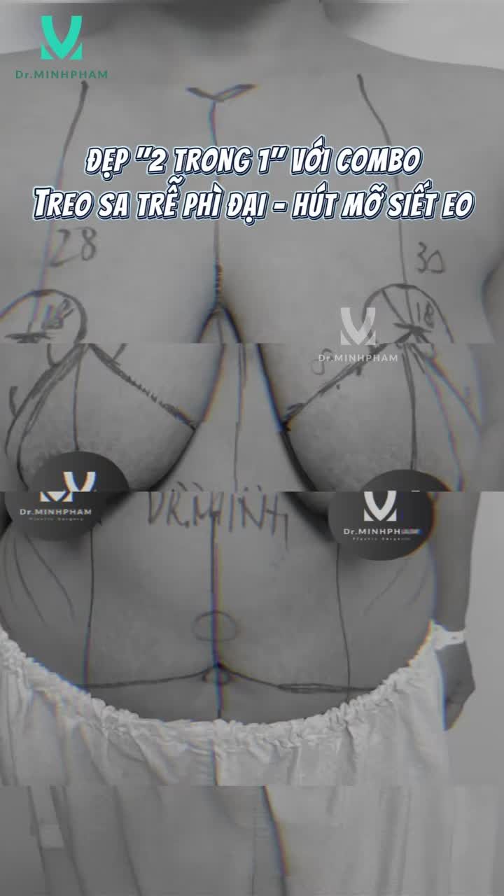 ĐẸP “2 TRONG 1” VỚI COMBO TREO SA TRỄ PHÌ ĐẠI - HÚT MỠ SIẾT EO